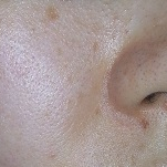 「気付けば…」【モニター20名様！】新発売！あごニキビに悩む方へのCCクリーム5000円相当の投稿画像