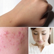 「CCクリーム」【モニター20名様！】新発売！あごニキビに悩む方へのCCクリーム5000円相当の投稿画像