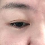 「二重がくっきりしました！」の画像（1枚目）
