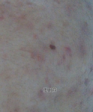 口コミ記事「思春期ニキビの赤いシミに使用」の画像