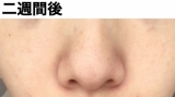 「たるみ毛穴に。」の画像（3枚目）