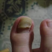 「つめ」【高齢者向け】足の爪が分厚くなってしまっている方募集の投稿画像