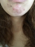 本当に厄介！顎ニキビ！！