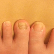 「親指の爪」【高齢者向け】足の爪が分厚くなってしまっている方募集の投稿画像