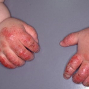 「スキンケア」【発売前新商品】アトピー性皮膚炎のお子様向けスキンケアモニター30名様大募集！の投稿画像