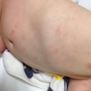 「1歳3カ月になる」【発売前新商品】アトピー性皮膚炎のお子様向けスキンケアモニター30名様大募集！の投稿画像