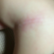 「すぐ赤くなる」【発売前新商品】アトピー性皮膚炎のお子様向けスキンケアモニター30名様大募集！の投稿画像