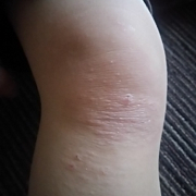 「子供の肌の写真」【発売前新商品】アトピー性皮膚炎のお子様向けスキンケアモニター30名様大募集！の投稿画像