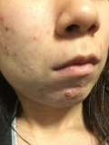 「右頬と顎のニキビ」の画像（1枚目）