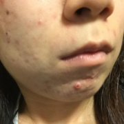 「右頬と顎のニキビ」【あごニキビ用オールインワンジェル・7000円相当を10名様に】モニター様大募集の投稿画像