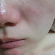 「ニキビになやんでます。」【あごニキビ用オールインワンジェル・7000円相当を10名様に】モニター様大募集の投稿画像