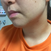 「真剣に悩んでいます。」【あごニキビ用オールインワンジェル・7000円相当を10名様に】モニター様大募集の投稿画像