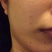 「アゴ周りのニキビです。ニキビ跡がなおりません。」【あごニキビ用オールインワンジェル・7000円相当を10名様に】モニター様大募集の投稿画像