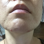 「あごニキビが・・・」【あごニキビ用オールインワンジェル・7000円相当を10名様に】モニター様大募集の投稿画像