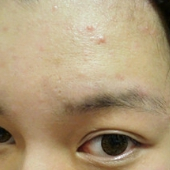 「顔出しＯＫです！ 　」【あごニキビ用オールインワンジェル・7000円相当を10名様に】モニター様大募集の投稿画像