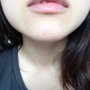 「顎もそうですが、額のニキビも合わせて気になってます」【あごニキビ用オールインワンジェル・7000円相当を10名様に】モニター様大募集の投稿画像