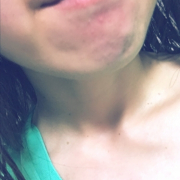 「あごニキビ」【あごニキビ用オールインワンジェル・7000円相当を10名様に】モニター様大募集の投稿画像