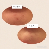 「日に日に薄くなるニキビ跡！」の画像