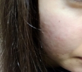 「にきび跡が薄くなりました！！」の画像