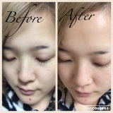 「ニキビができなくなりました！」の画像