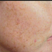 「顔出しＯＫです！ 　」【本品1万円相当と謝礼1万円】乾燥肌・敏感肌用美白クリーム長期モデルモニター募集の投稿画像