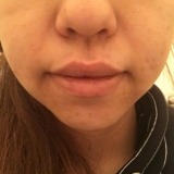 「痛いニキビが出来にくくなった」の画像