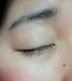 アトピーでかゆくて目の周りを掻いてしまい、毛が抜ける