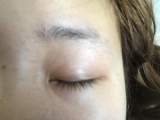 左まぶた
