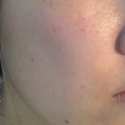 「肌の悩み」【ハイム化粧品】薬用美白化粧水　顔出しモニター３０名募集♪♪♪の投稿画像