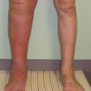 「顔出しＯＫです！」★パンパンでつらい・・・むくみにお悩みの方大募集★の投稿画像