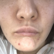 「ニキビ」【顔出し】【本品】大人気！新VCローションの長期1ヶ月モニター♪_180411の投稿画像