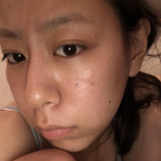 「ニキビ跡しみ！」【顔出し】【本品】大人気！新VCローションの長期1ヶ月モニター♪_180411の投稿画像