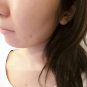 「あご回りのニキビ」【顔出し】【本品】大人気！新VCローションの長期1ヶ月モニター♪_180411の投稿画像