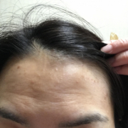 「肌のコンプレックス」【顔出し】【本品】大人気！新VCローションの長期1ヶ月モニター♪_180411の投稿画像