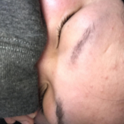 「ニキビが次から次えと」【顔出し】【本品】大人気！新VCローションの長期1ヶ月モニター♪_180411の投稿画像