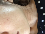 「ニキビの数が減りました」の画像