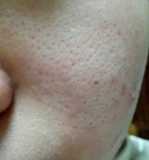 「10日目！ ニキビやニキビ跡、毛穴の開きが少しずつ良くなっています。」の画像（3枚目）