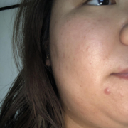 「ニキビできちゃった」肌自慢コンテスト開催！★VCローションお試しサイズをプレゼント♪20180615の投稿画像