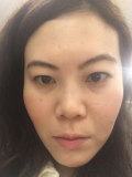 右頬のシミっぽくなっている部分です