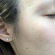 「ニキビ跡がコンプレックス…」【顔出しOK】【本品】大人気！新VCローションの長期1ヶ月モニター♪180727の投稿画像