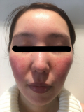 「肌の赤みを解消したいです！」の画像