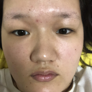 「毛穴とニキビ跡とおでこ」★塗るだけフェイスマスク★　薬用リペアベールエッセンス　長期モニター募集！！の投稿画像