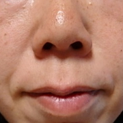 「どんどん増え続けるシワと毛穴の目立ち。そしていちご鼻」★塗るだけフェイスマスク★　薬用リペアベールエッセンス　長期モニター募集！！の投稿画像