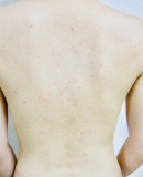 背中湿疹痒み(;;)