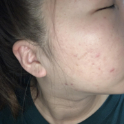 「昔から肌トラブルがあります」低刺激◎赤らみ・痒みケア！≪脂漏性皮膚炎用≫化粧水モニター大募集（377）の投稿画像