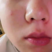 「ニキビが多い。」低刺激◎赤らみ・痒みケア！≪脂漏性皮膚炎用≫化粧水モニター大募集（377）の投稿画像