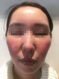 「まだらな赤みと肌のブツブツ」の画像（1枚目）