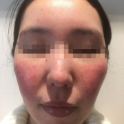 「まだらな赤みと肌のブツブツ」低刺激◎赤らみ・痒みケア！≪脂漏性皮膚炎用≫化粧水モニター大募集（377）の投稿画像