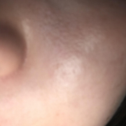 「テカリと赤み」低刺激◎赤らみ・痒みケア！≪脂漏性皮膚炎用≫化粧水モニター大募集（377）の投稿画像