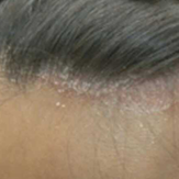 「脂漏性皮膚炎部位」低刺激◎赤らみ・痒みケア！≪脂漏性皮膚炎用≫化粧水モニター大募集（377）の投稿画像